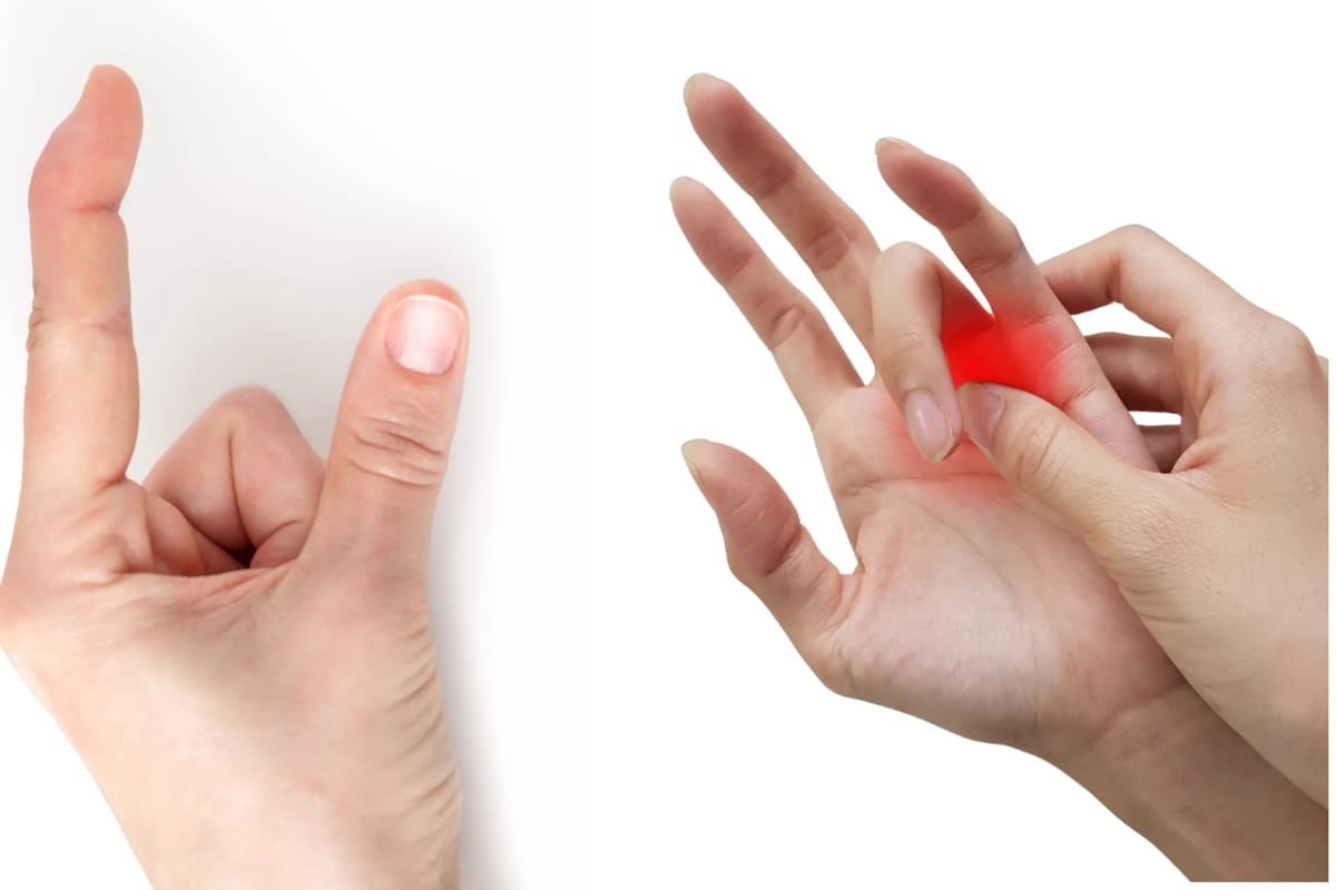 فیزیوتراپی برای درمان انگشت ماشه ای