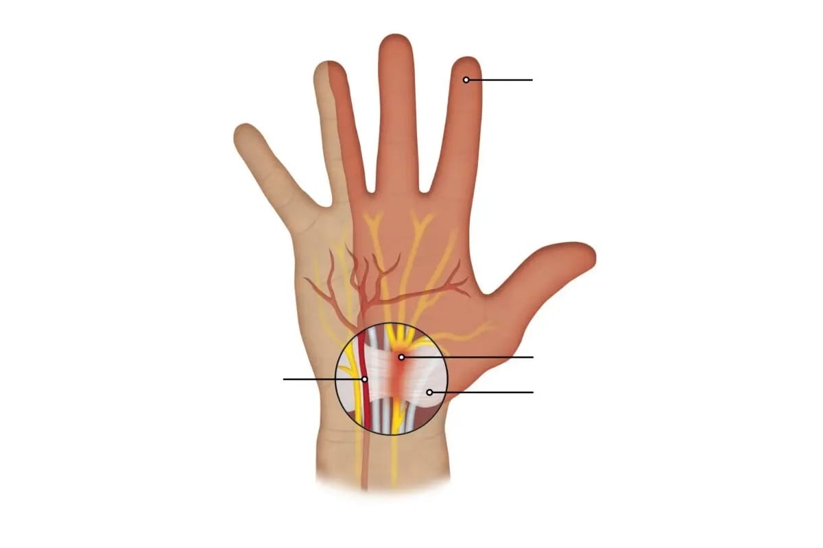 علل بهوجود آمدن سندروم تونل کارپال