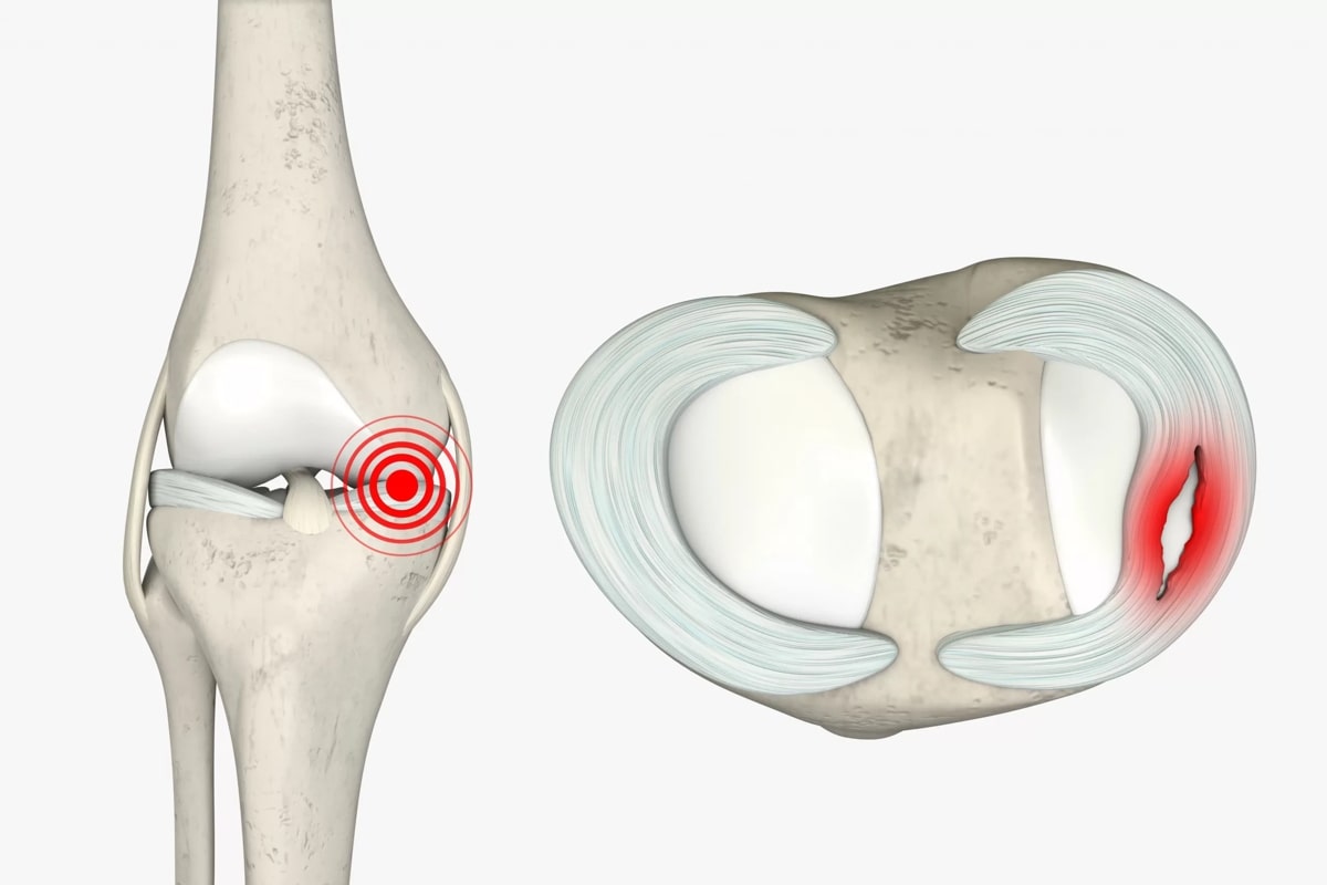 پارگی مینیسک زانو