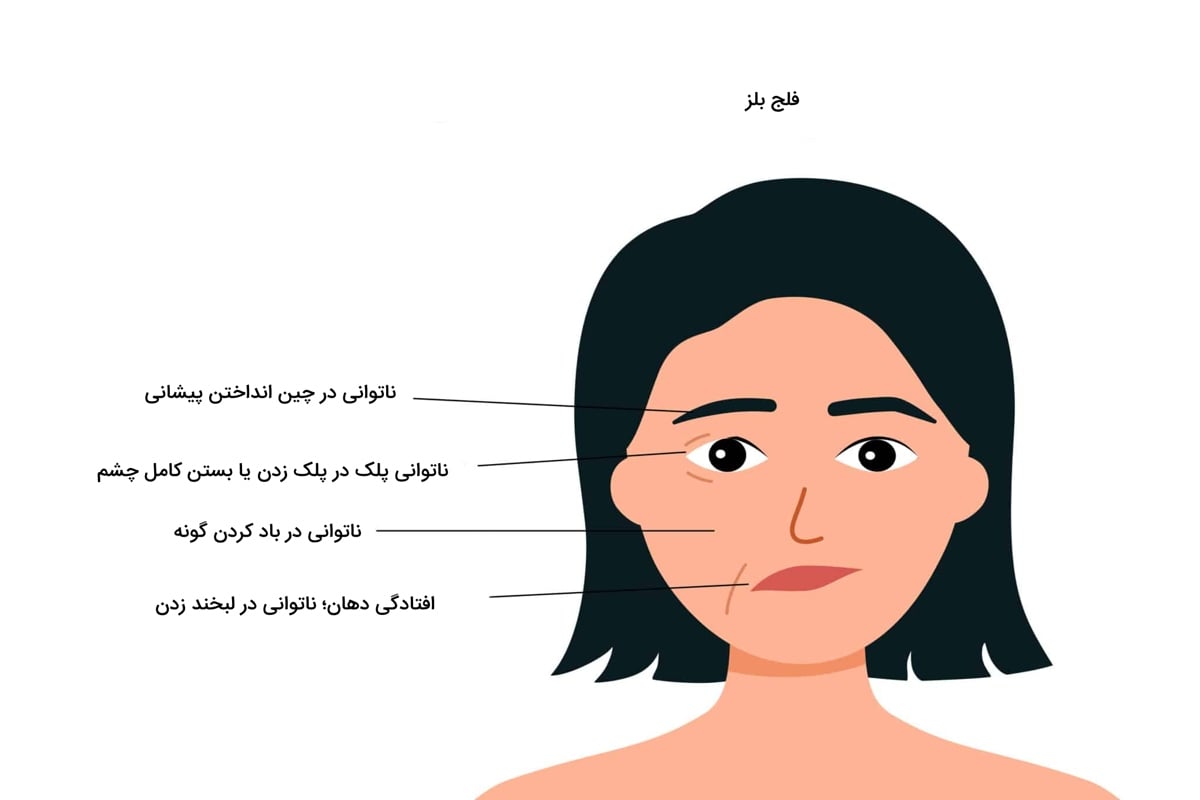 فلج بلز چیست؟