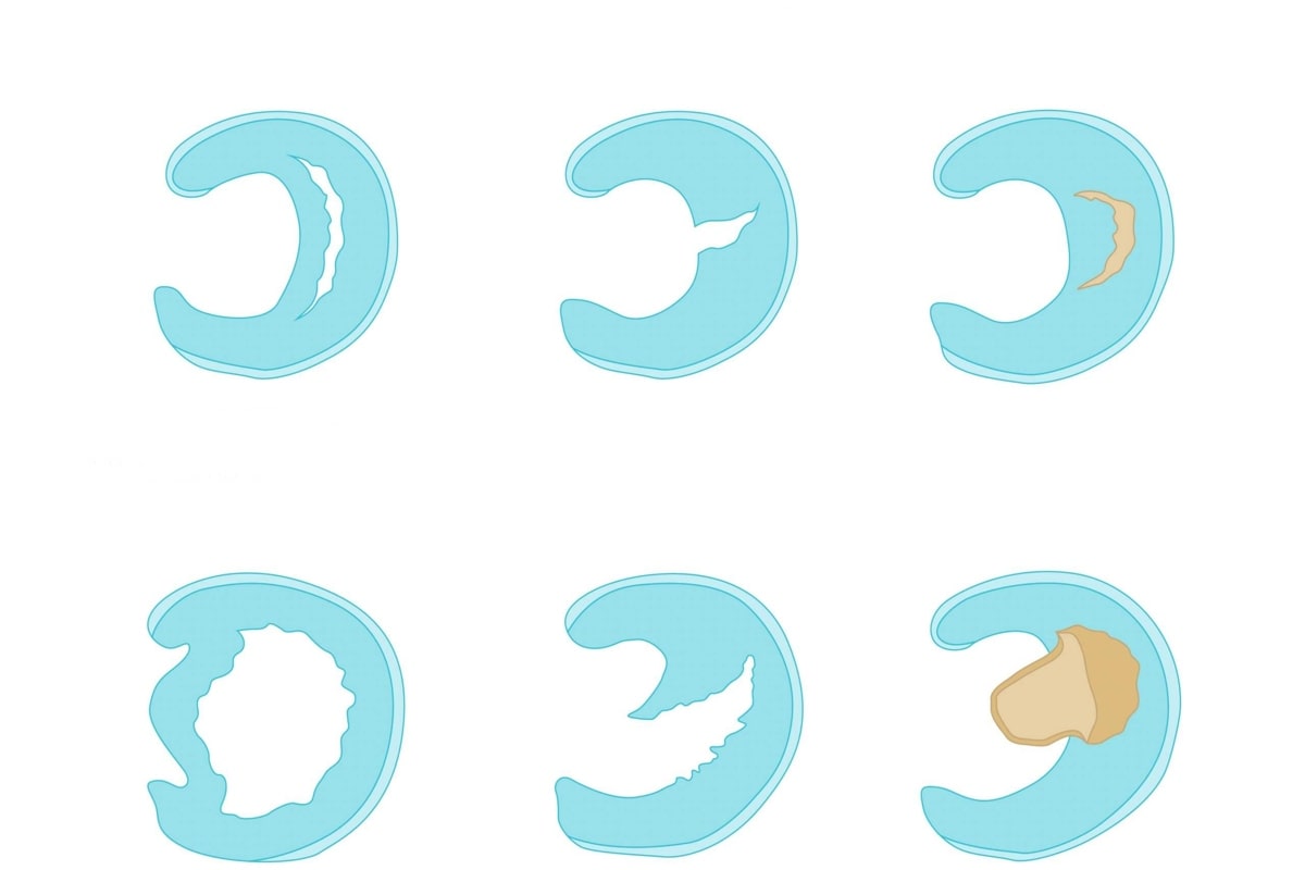 نوع پارگی مینیسک زانو