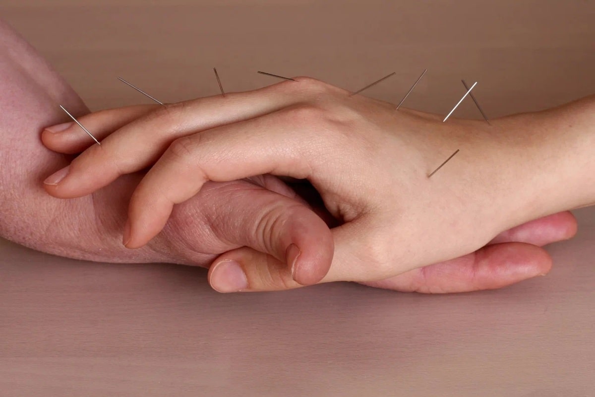 طب سوزنی و سوزن خشک