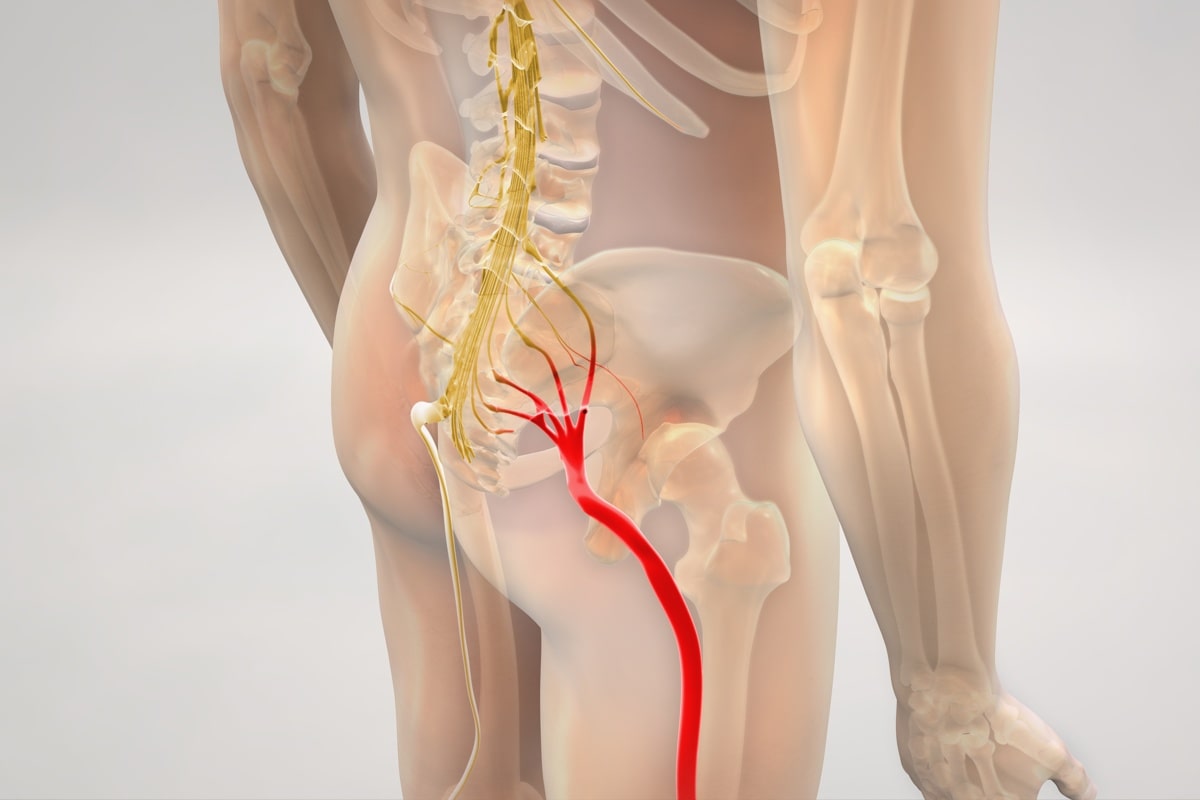 آسیب عصب سیاتیک ناشی از تزریق