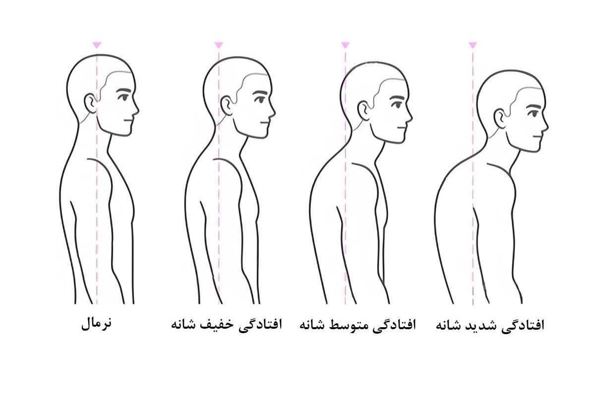 افتادگی شانه دقیقا چیست