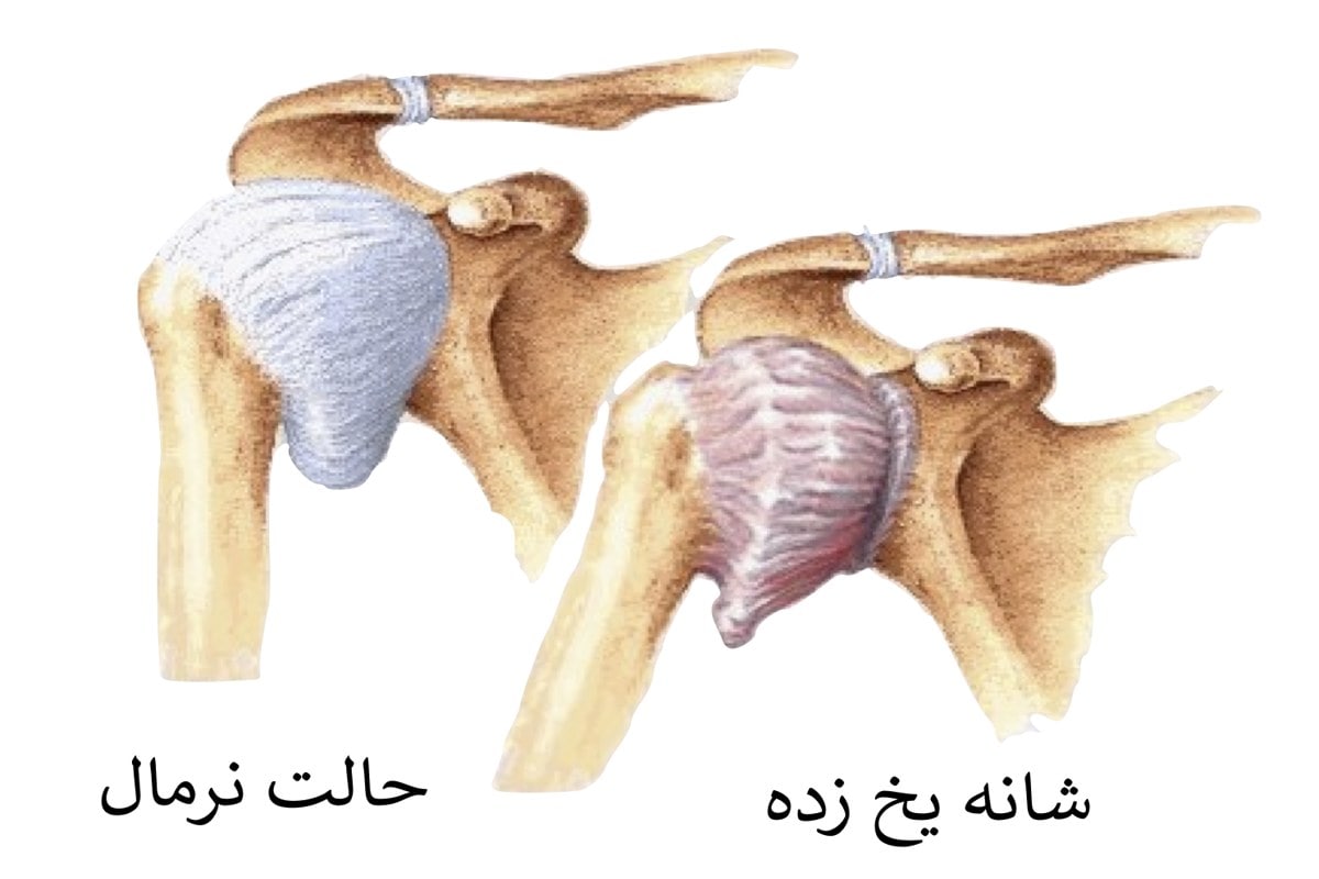 زمان مراجعه به فیزیوتراپی برای شانه یخ زده