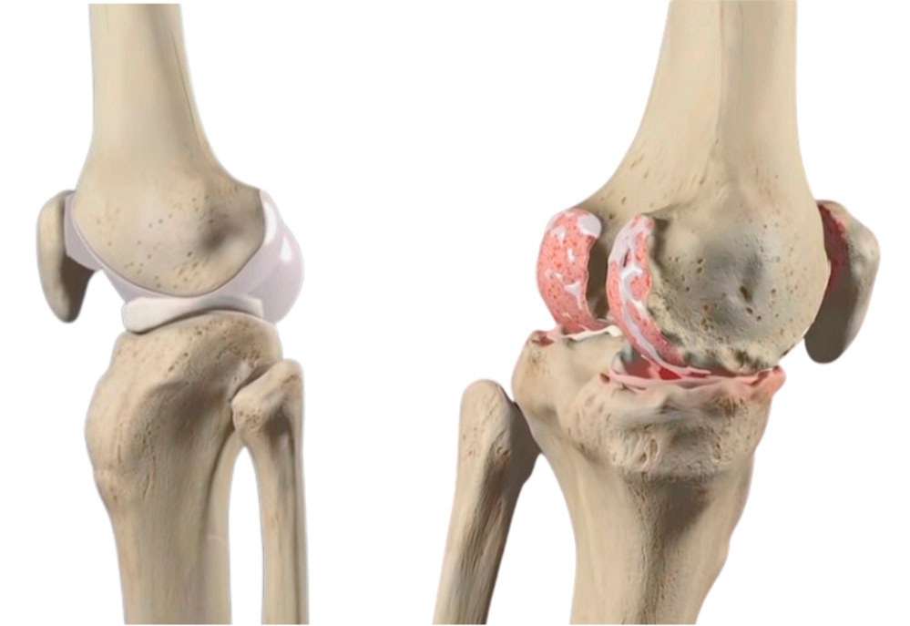 دلیل صدا دادن زانو