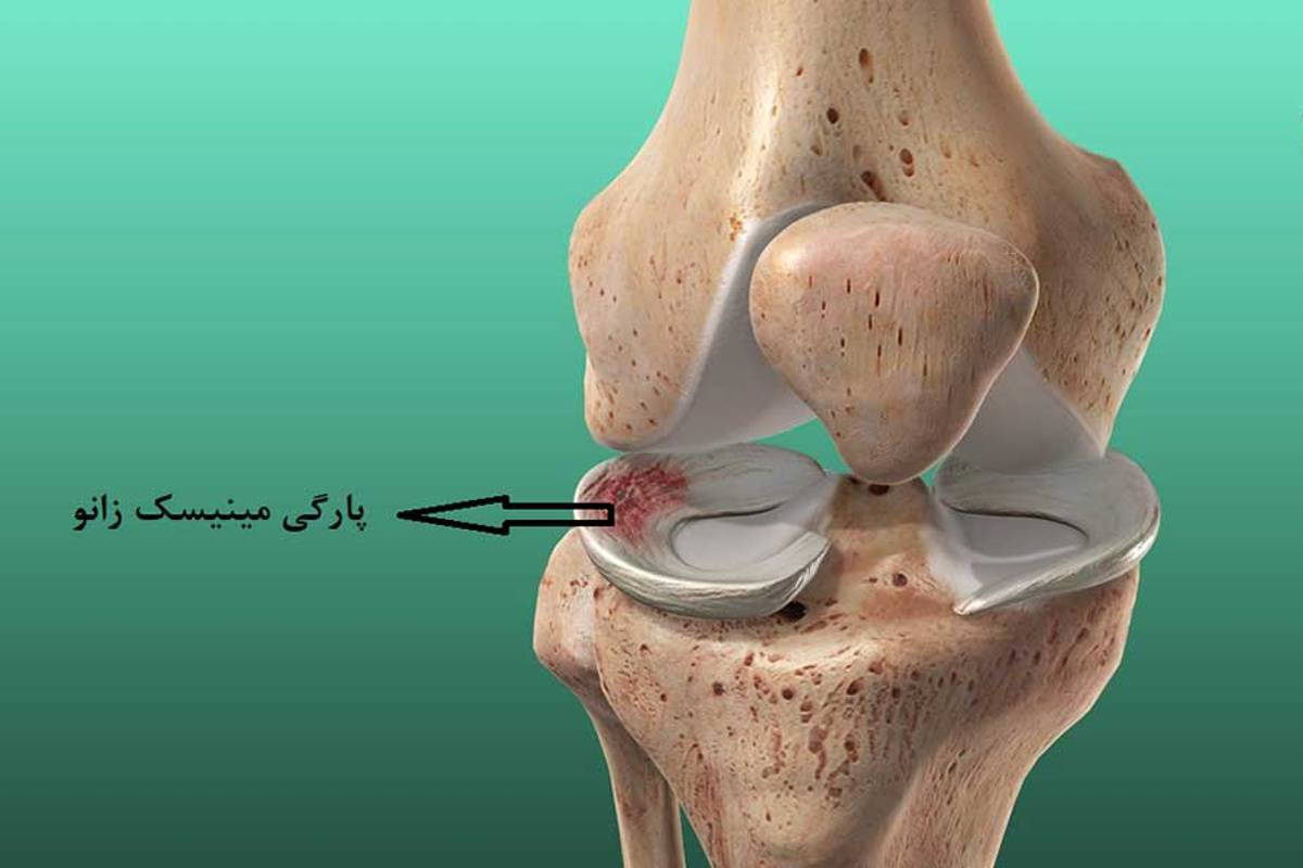 مکانیسم آسیب مینیسک زانو