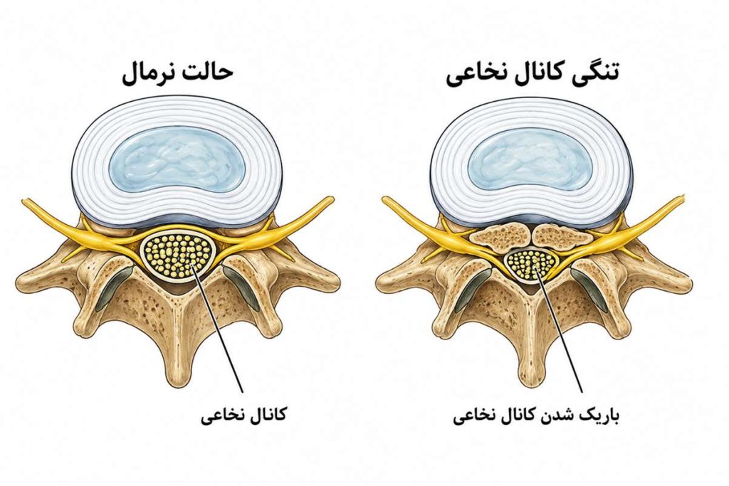 فیزیوتراپی تنگی کانال نخاعی